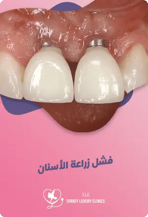 فشل زراعة الأسنانfeatured image