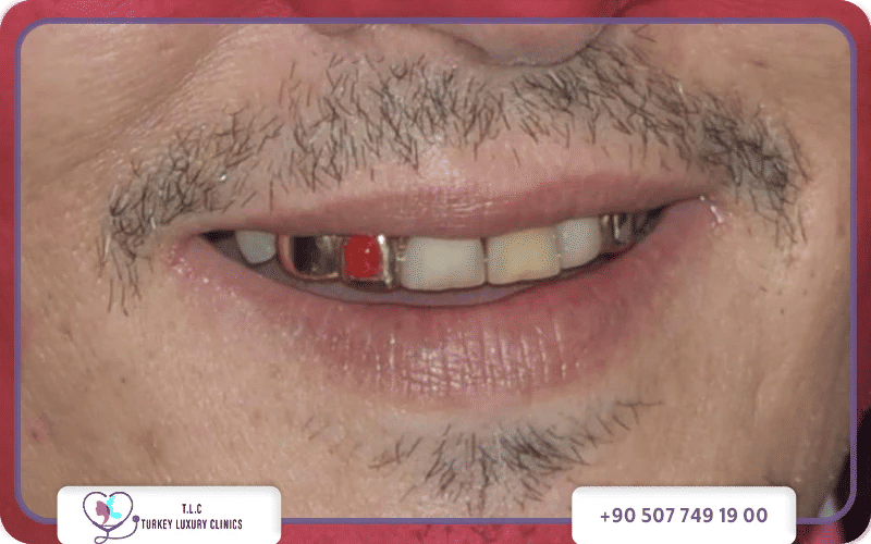 Johnny Depp teeth before and after 2024 – stained worn teeth vs bright white Hollywood smile transformation
