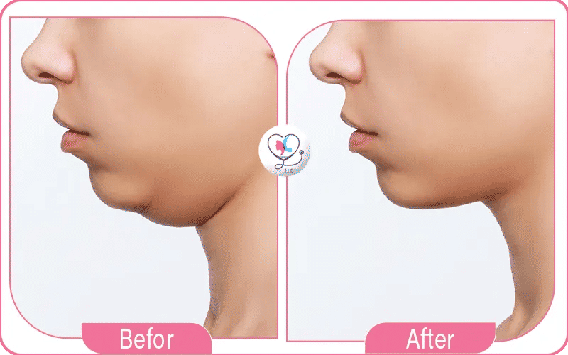 ما هي عملية إزالة اللغلوغ بالليزر؟