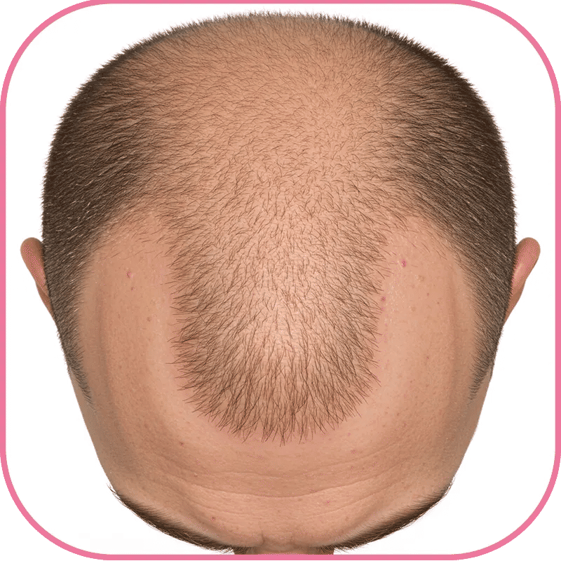 What to Expect 4 Months After Hair Transplant?