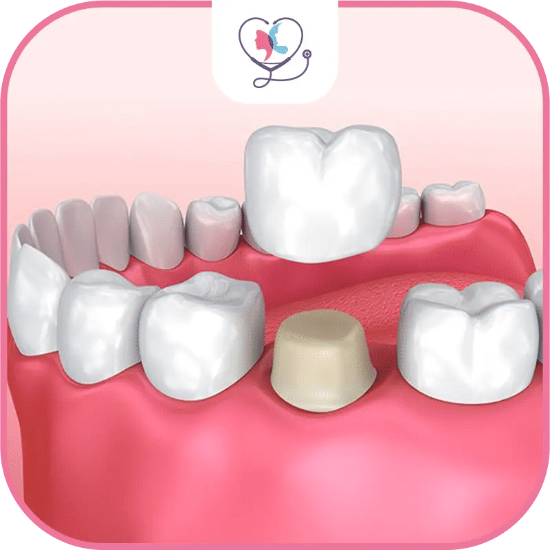 Quand avez-vous besoin d'une couronne dentaire ?