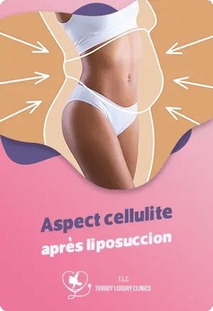Aspect cellulite après liposuccion : Pourquoi persiste-t-elle ?featured image