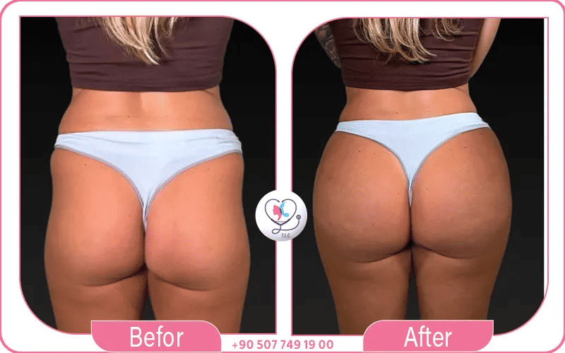 كم مل فيلر تحتاج المؤخرة؟