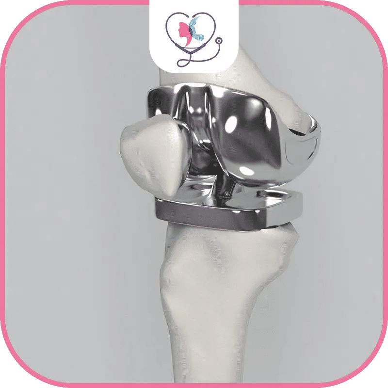 عملية تغيير مفصل الركبة في تركيا: دليلك الشامل