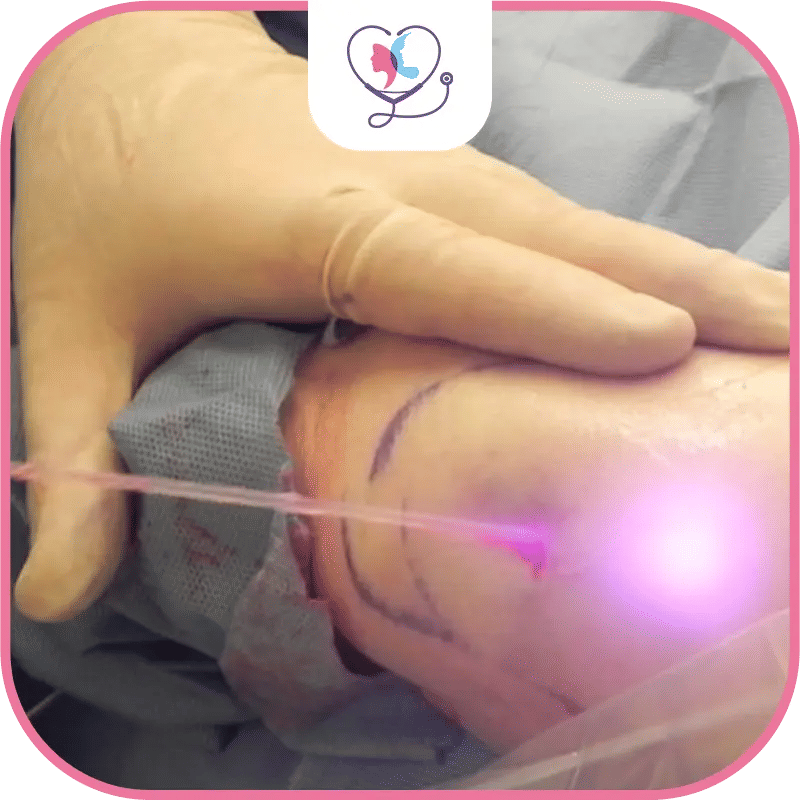 ما هو شفط الدهون بالليزر؟