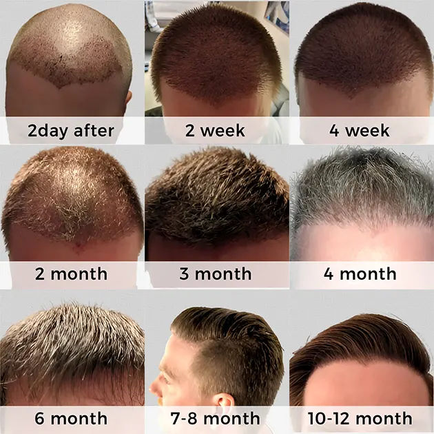 Hair Transplant Week by Week: From Week 1 to Week 48 