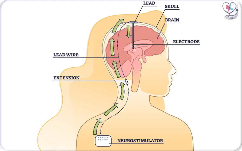 What is Deep Brain Stimulation Surgery? 2