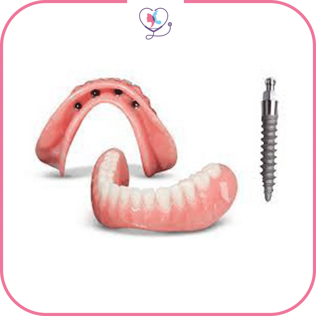 ما هي زراعة الأسنان المصغرة؟