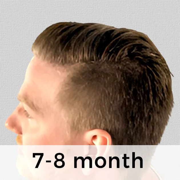 Hair Transplant Week by Week: From Week 1 to Week 48 