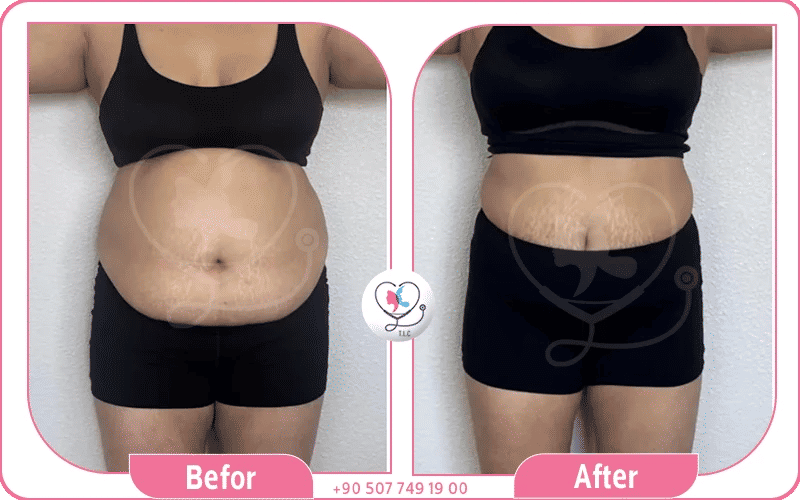 النظام الغذائي مع ابر المنجارو 