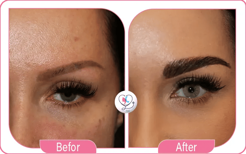 Eyebrow Transplant Before and After Photos