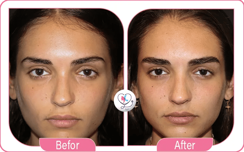 Get Your Eyebrow Transplant with Confidence at Turkey Luxury Clinics