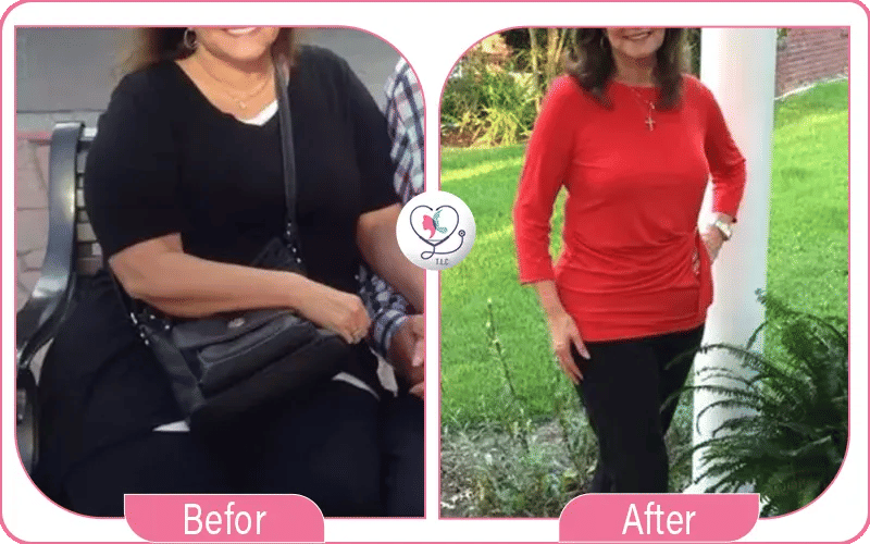 مميزات تجربتي مع حقن المعدة بالبوتوكس