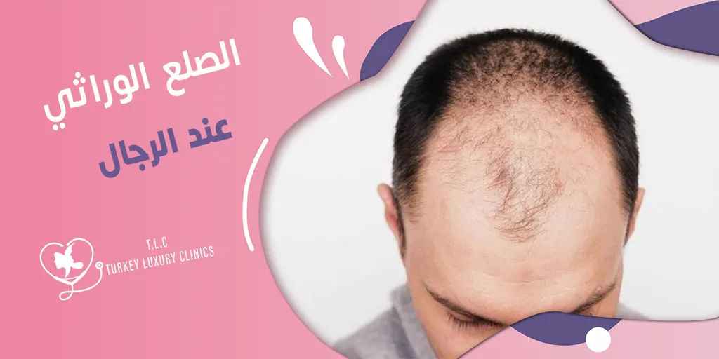 الصلع الوراثي عند الرجال: بدايته وتطوره وعلاجه
