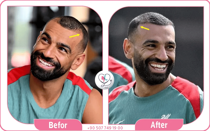 زراعة شعر محمد صلاح قبل وبعد بالصور