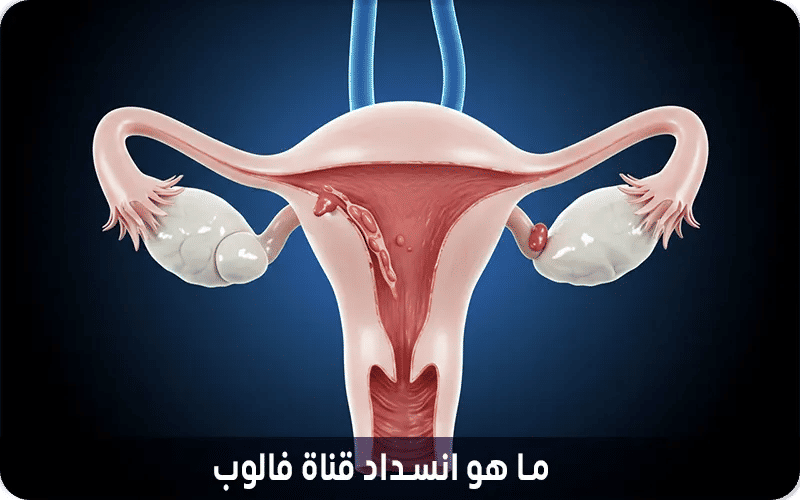 ما هو انسداد قناة فالوب