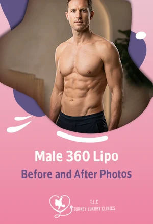 Male 360 Lipo Before and After Photos: Torso, Chest & Abs