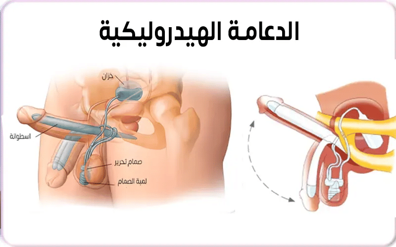 مميزات وعيوب الدعامة الهيدروليكية