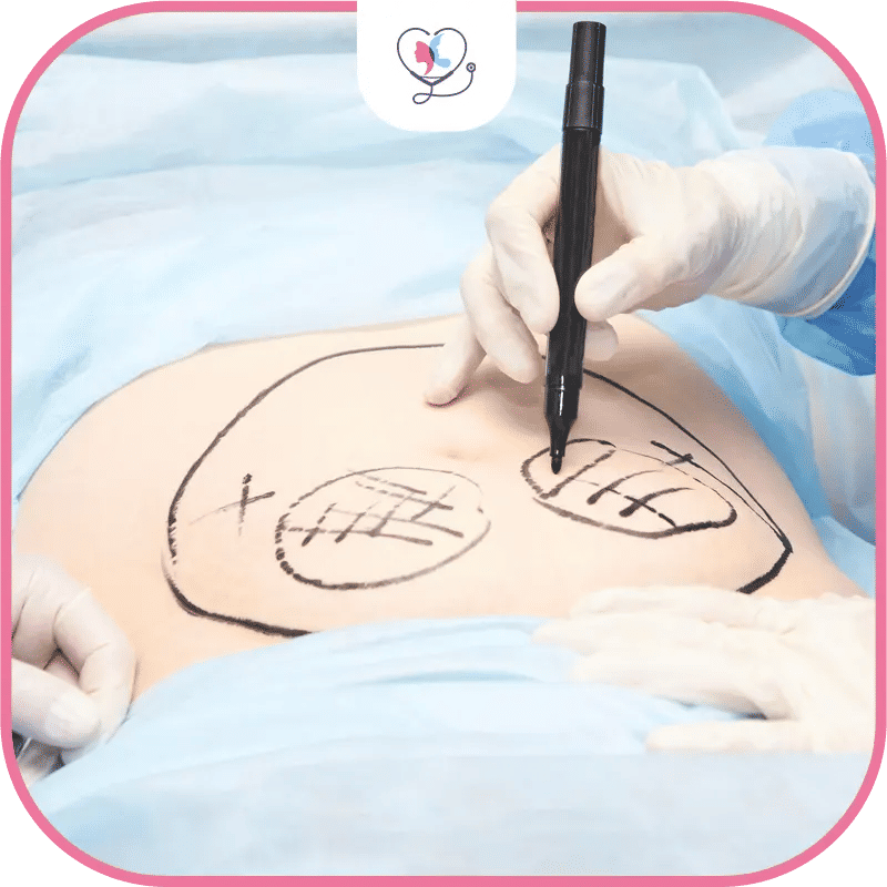 العوامل التي تؤثر على تكلفة شفط الدهون في تركيا