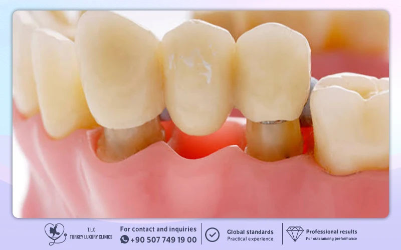 Producing and fitting the permanent crowns or bridge