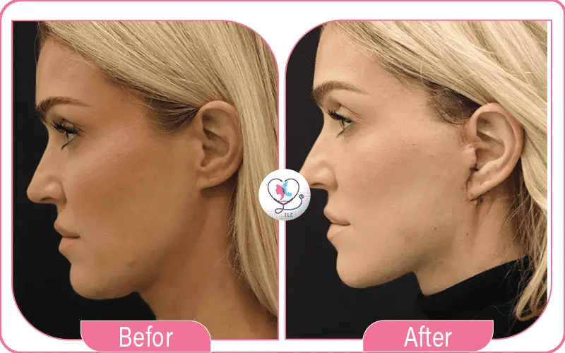 Qu’est-ce qu’un mini lifting du visage ?