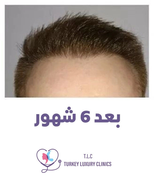 مرحلة نمو الشعر النشطة (4-6 أشهر)