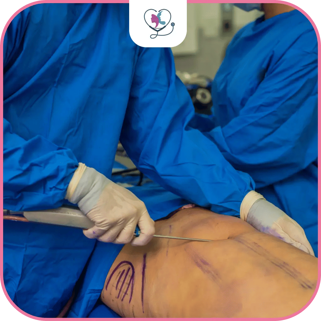 عملية شد البطن الجراحي في تركيا 