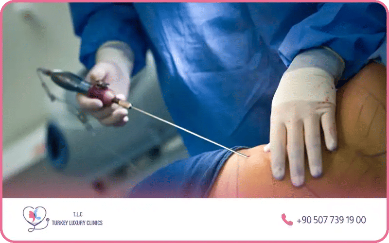 Le choix esthétique pour perdre du ventre