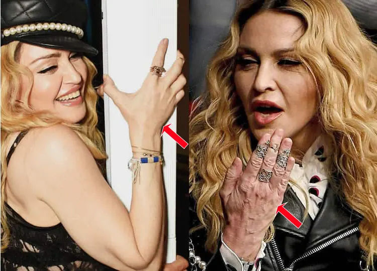 Image comparing Madonna before and after reported cosmetic enhancements.