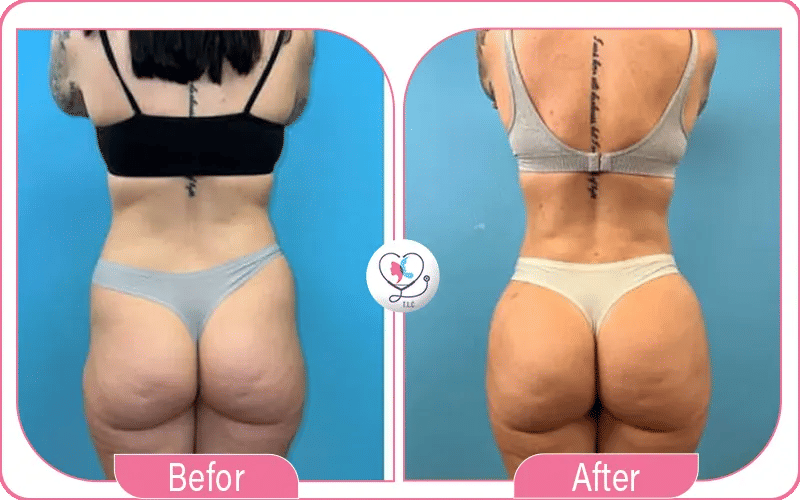 Mommy Makeover with BBL Before and After