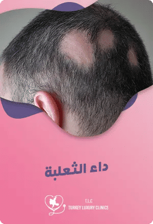 ماهو علاج الثعلبة في تركيا؟featured image