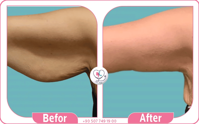arm lift before and after showcasing dramatic sagging skin reduction in istanbul turkey