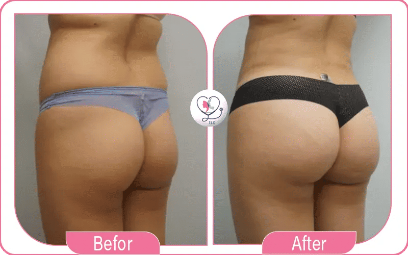 تجارب ناجحة أخرى في تكبير المؤخرة بعدة تقنيات