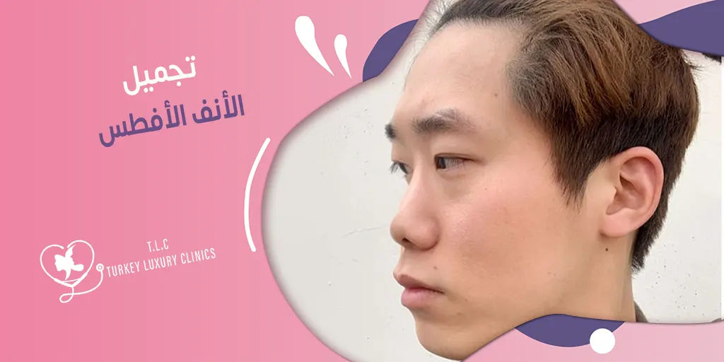 تجميل الأنف الأفطس: النتائج بالصور مع الأسعار