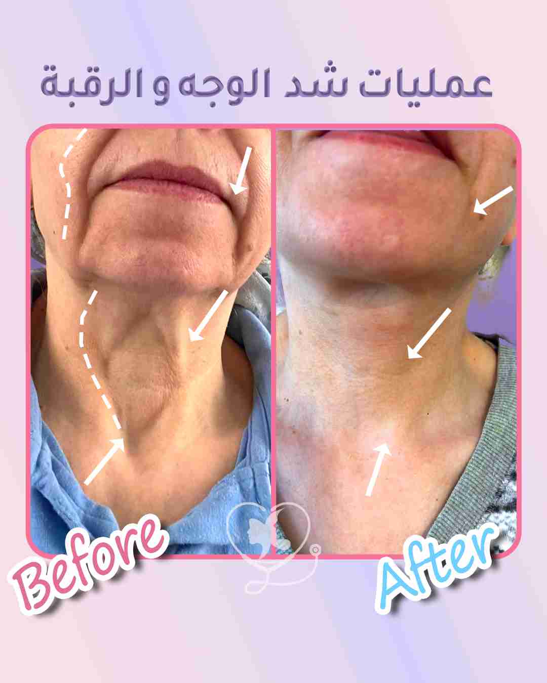 فوائد عملية شد الوجه