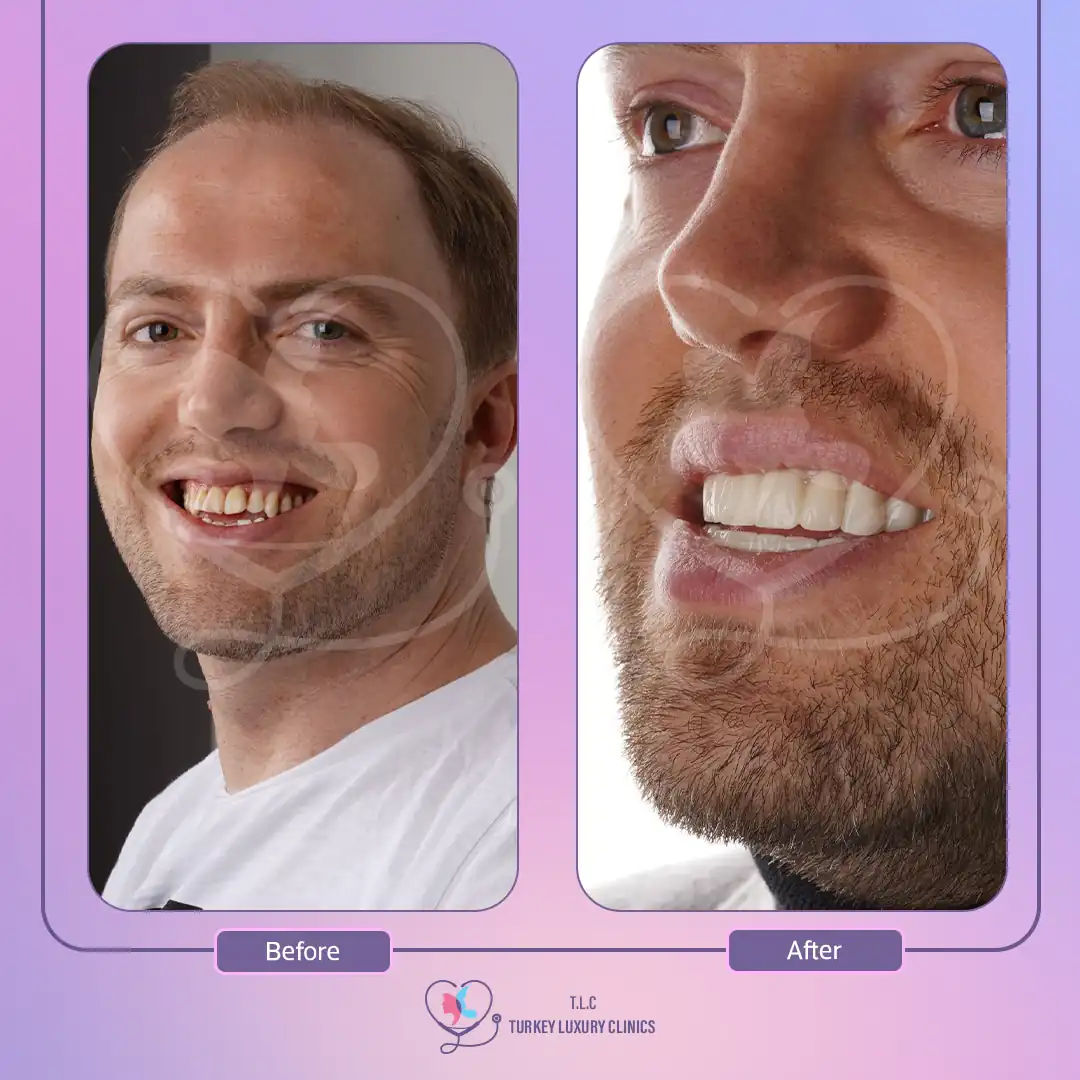 اسعار ابتسامة هوليود 3d