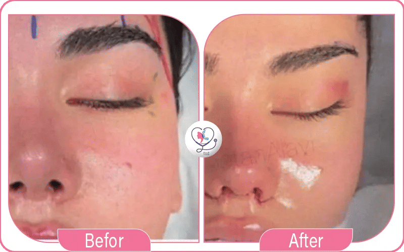 صور عملية عيون القطة قبل و بعد