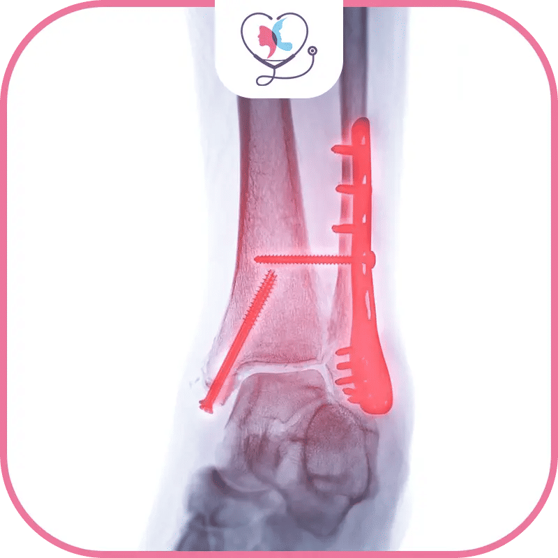 تكلفة جراحة القدم والكاحل في تركيا