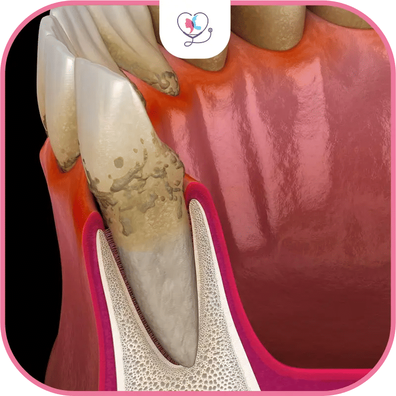 tartres sur les dents