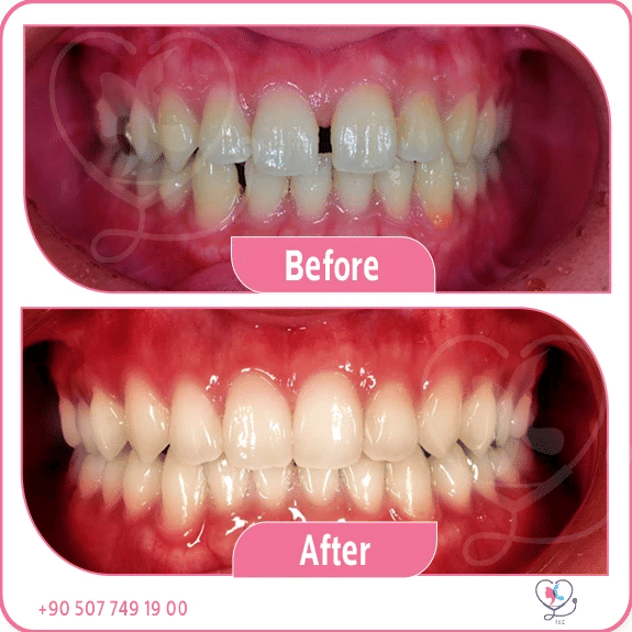 Dental veneers before and after Turkey – patient smile makeover results at Turkey Luxury Clinics Istanbul