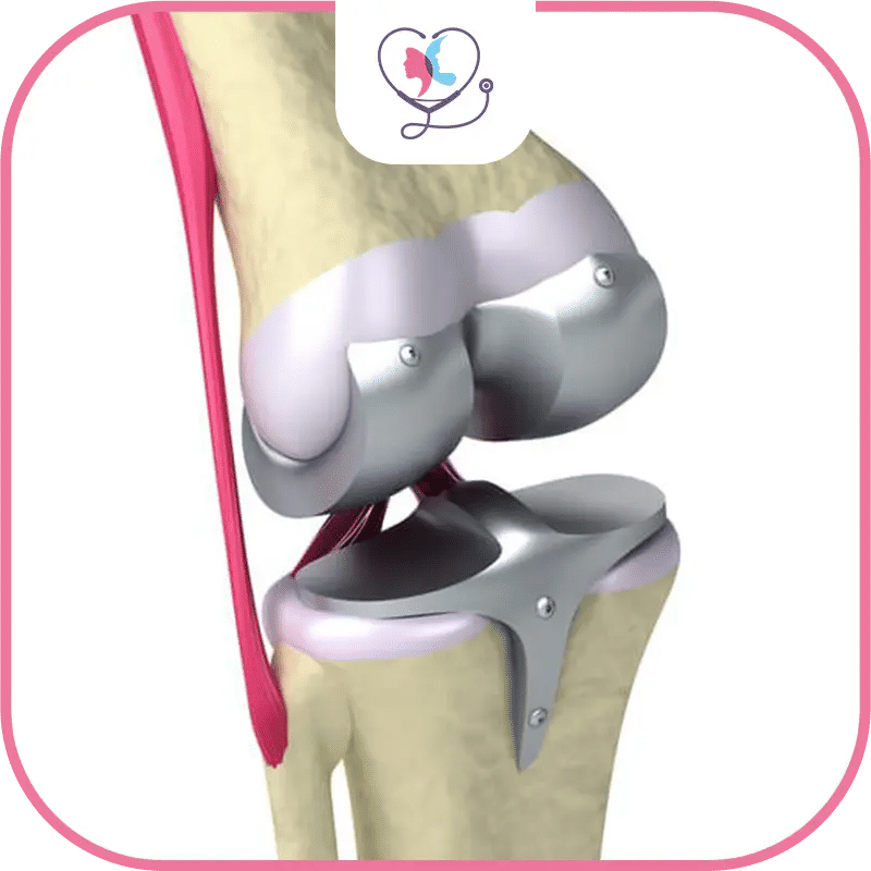 What is knee replacement surgery?