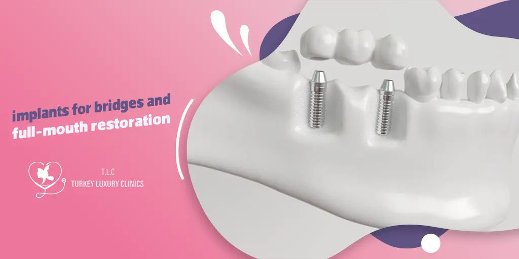 Multiple Teeth Missing? Implants for Bridges and Full-mouth Restoration