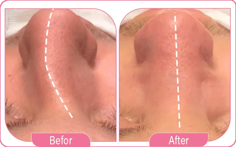 نسبة نجاح عملية انحراف الحاجز الأنفي