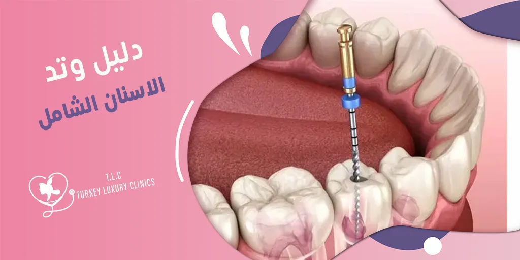 وتد الاسنان: دليل شامل الأنواع، وطربقة التركيب، والأسعار 2026