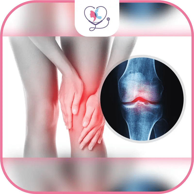 Symptoms of Knee Arthritis