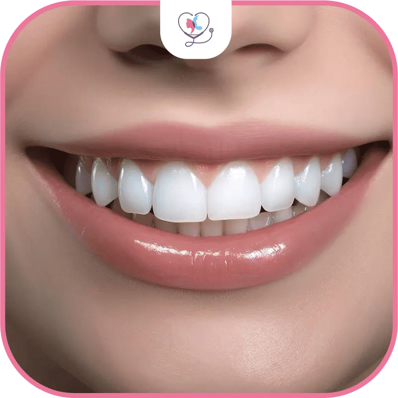 facette dentaire turquie avis - facette dentaire turquie danger