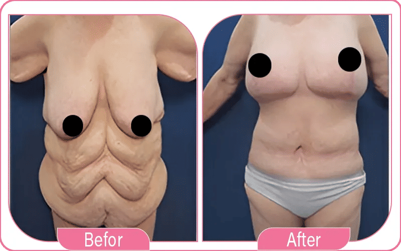 How Long Does It Take for Loose Skin to Tighten After Weight Loss?