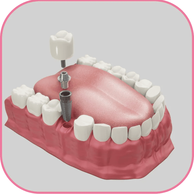 Why Choose Turkey for a Minimally Invasive Dental Implant?