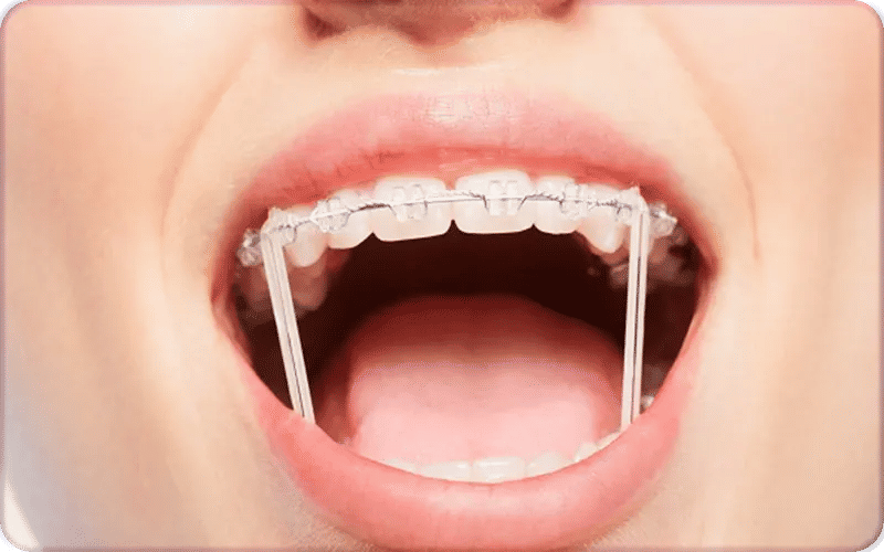 Invisalign With vs. Without Rubber Bands for Overbite