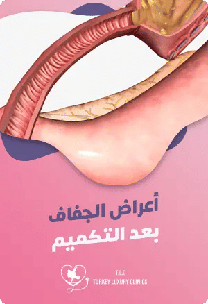 أعراض الجفاف بعد عملية التكميمfeatured image